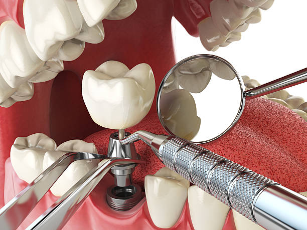 Best Tooth Infection Emergency Dentist  in Stlman Valley, IL