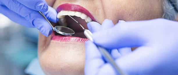 Best Chipped Tooth Repair Near Me  in Stlman Valley, IL
